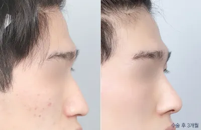 Before & After