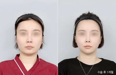 Before & After
