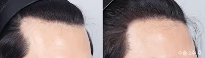 Before & After