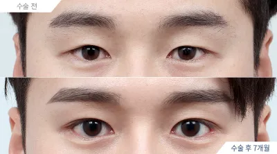 Before & After