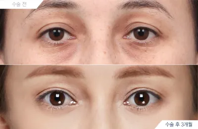 Before & After