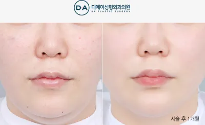 Before & After