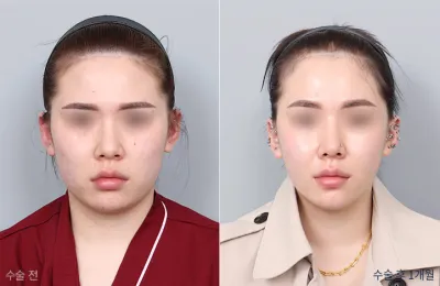 Before & After