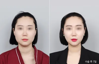 Before & After