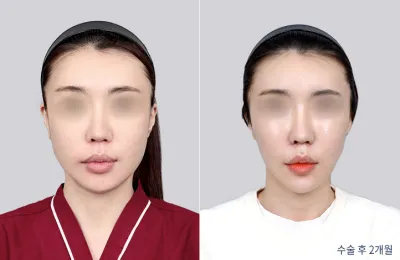 Before & After