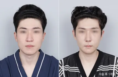 Before & After