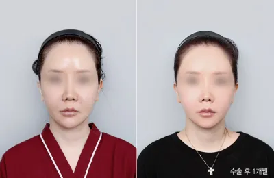 Before & After