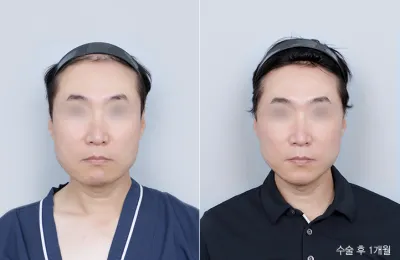 Before & After