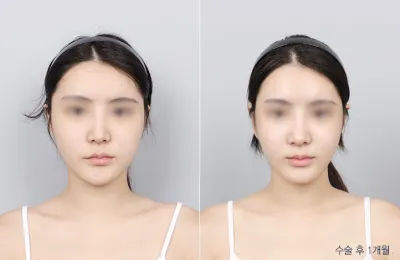 Before & After