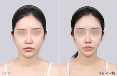 Before & After