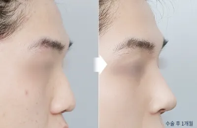 Before & After