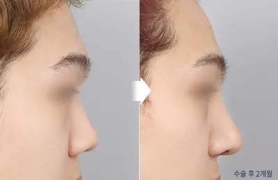 Before & After