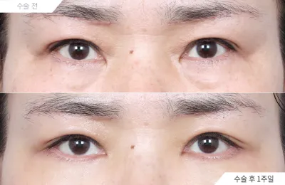Before & After