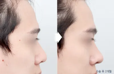 Before & After