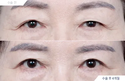 Before & After