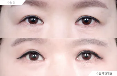 Before & After