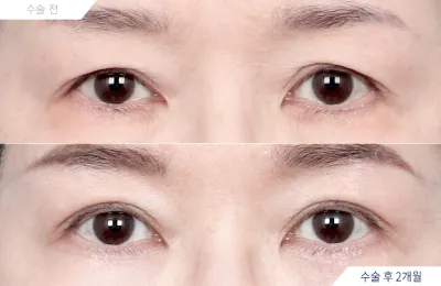 Before & After