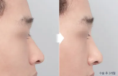 Before & After