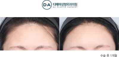 Before & After