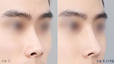 Before & After