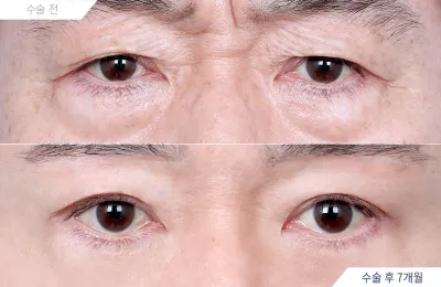 Before & After