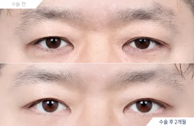Before & After