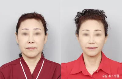Before & After