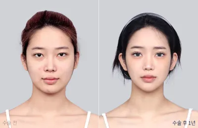 Before & After