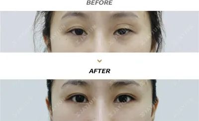 Before & After