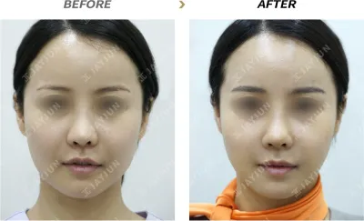 Before & After