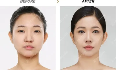 Before & After
