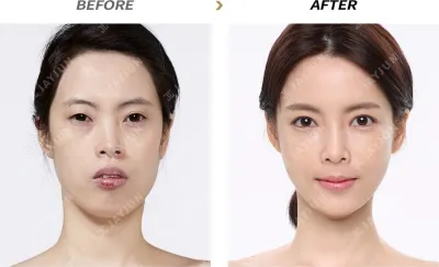 Before & After