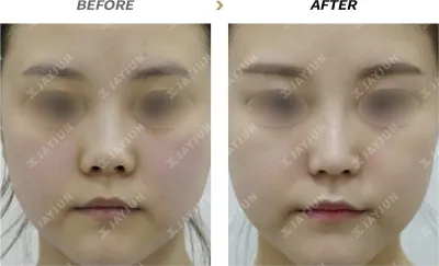Before & After