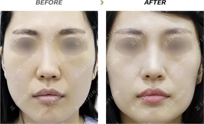 Before & After