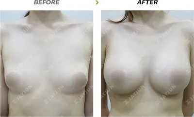 Before & After