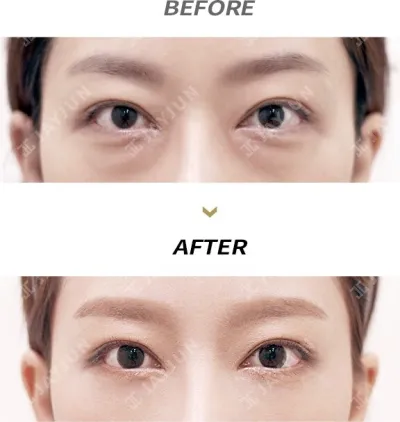 Before & After