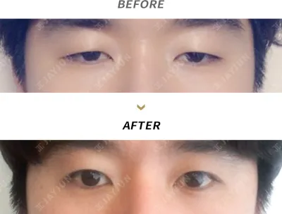 Before & After