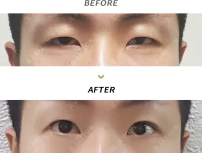 Before & After