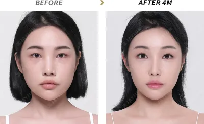 Before & After