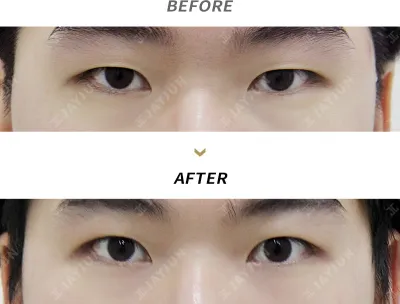 Before & After