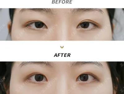 Before & After