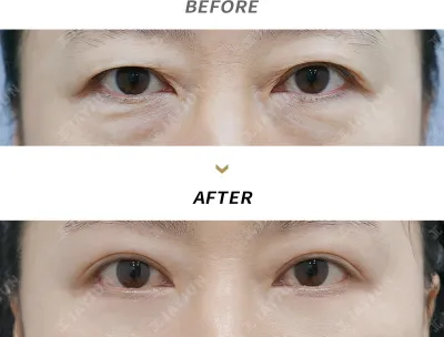 Before & After
