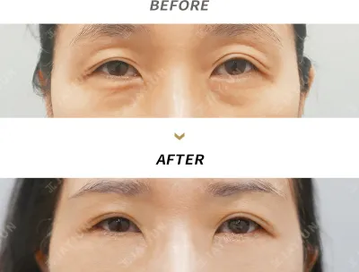 Before & After