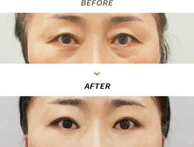 Before & After