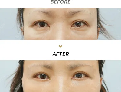 Before & After