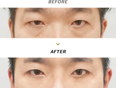 Before & After