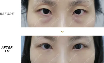 Before & After