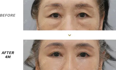 Before & After