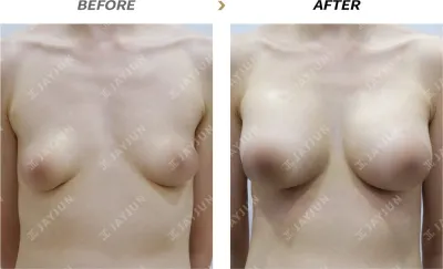 Before & After