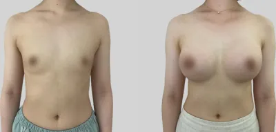 Before & After